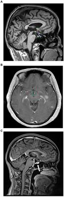 Frequency of metastases within the hypothalamic–pituitary area and the associated high-risk factors in patients with brain metastases